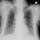 Mediastinal lymphadenopathy, malignant lymphoma, correlation: X-ray - Plain radiograph