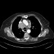 Mediastinal lymphadenopathy, malignant lymphoma, correlation: CT - Computed tomography