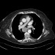 Mediastinal lymphadenopathy, malignant lymphoma, correlation: CT - Computed tomography