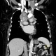 Mediastinal lymphadenopathy, malignant lymphoma, correlation: CT - Computed tomography