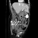 Mesenterial ischemia, gas in portal vein: CT - Computed tomography