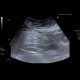 Mesenteric lipodystrophy, paniculitis: US - Ultrasound