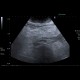 Mesenteric lipodystrophy, paniculitis: US - Ultrasound