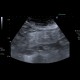 Mesenteric lipodystrophy, paniculitis: US - Ultrasound