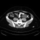 Mesentric cyst, mesothelial cyst: CT - Computed tomography