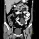 Mesentric cyst, mesothelial cyst: CT - Computed tomography