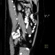 Mesentric cyst, mesothelial cyst: CT - Computed tomography