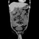 Mesenterium commune, gut malrotation, Crohn's disease of terminal ileum: CT - Computed tomography