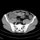 Mesenterium commune, gut malrotation, Crohn's disease of terminal ileum: CT - Computed tomography