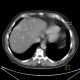 Liver metastasis of adenocarcinoma of colon, colorectal carcinoma, biopsy: CT - Computed tomography