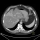 Liver metastasis of adenocarcinoma of colon, colorectal carcinoma, biopsy: CT - Computed tomography