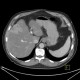 Liver metastasis of adenocarcinoma of colon, colorectal carcinoma, biopsy: CT - Computed tomography