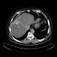 Liver metastasis of adenocarcinoma of colon, colorectal carcinoma, biopsy: CT - Computed tomography