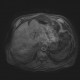 Liver metastasis of adenocarcinoma of colon, colorectal carcinoma, biopsy: MRI - Magnetic Resonance Imaging