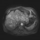 Liver metastasis of adenocarcinoma of colon, colorectal carcinoma, biopsy: MRI - Magnetic Resonance Imaging