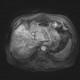 Liver metastasis of adenocarcinoma of colon, colorectal carcinoma, biopsy: MRI - Magnetic Resonance Imaging