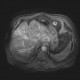 Liver metastasis of adenocarcinoma of colon, colorectal carcinoma, biopsy: MRI - Magnetic Resonance Imaging