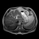 Liver metastasis of adenocarcinoma of colon, colorectal carcinoma, biopsy: MRI - Magnetic Resonance Imaging