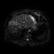 Liver metastasis of adenocarcinoma of colon, colorectal carcinoma, biopsy: MRI - Magnetic Resonance Imaging