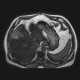 Liver metastasis of adenocarcinoma of colon, colorectal carcinoma, biopsy: MRI - Magnetic Resonance Imaging