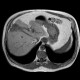 Liver metastasis of adenocarcinoma of colon, colorectal carcinoma, biopsy: MRI - Magnetic Resonance Imaging