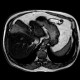 Liver metastasis of adenocarcinoma of colon, colorectal carcinoma, biopsy: MRI - Magnetic Resonance Imaging