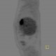 Liver metastasis of adenocarcinoma of colon, colorectal carcinoma, biopsy: NM - Nuclear medicine