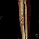 Metastasis of melanoma in the tibia: CT - Computed tomography