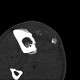 Metastasis of melanoma in the tibia: CT - Computed tomography