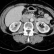 Metastasis in duodenal wall: CT - Computed tomography