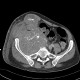Tumour of cecum, gigantic, osteolysis of lumbar vertebra: CT - Computed tomography