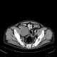 Melanoma, metastases of malignant melanoma in peritoneal cavity: CT - Computed tomography