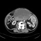 Melanoma, metastases of malignant melanoma in peritoneal cavity: CT - Computed tomography