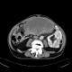 Melanoma, metastases of malignant melanoma in peritoneal cavity: CT - Computed tomography