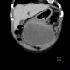 Melanoma, metastases of malignant melanoma in peritoneal cavity: CT - Computed tomography