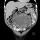 Melanoma, metastases of malignant melanoma in peritoneal cavity: CT - Computed tomography