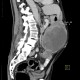 Melanoma, metastases of malignant melanoma in peritoneal cavity: CT - Computed tomography