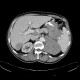 Metastases of malignant melanoma, liver, stomach, adrenal gland, retroperitoneal lymph nodes: CT - Computed tomography