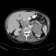 Metastases of malignant melanoma, liver, stomach, adrenal gland, retroperitoneal lymph nodes: CT - Computed tomography