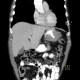 Metastases of malignant melanoma, liver, stomach, adrenal gland, retroperitoneal lymph nodes: CT - Computed tomography