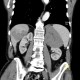 Metastases of malignant melanoma, liver, stomach, adrenal gland, retroperitoneal lymph nodes: CT - Computed tomography