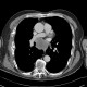 Metastatic disease of lung, pleural metastases: CT - Computed tomography