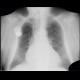 Lung congestion, first degree: X-ray - Plain radiograph