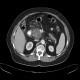 Serous adenoma of pancreas, microcystic: CT - Computed tomography