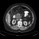 Serous adenoma of pancreas, microcystic: CT - Computed tomography