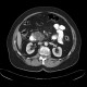 Serous adenoma of pancreas, microcystic: CT - Computed tomography