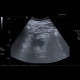 Serous adenoma of pancreas, microcystic: US - Ultrasound