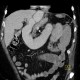 Migration of stent, ileus: CT - Computed tomography