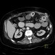 Migration of stent, ileus: CT - Computed tomography