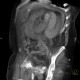 Migration of stent, ileus: CT - Computed tomography